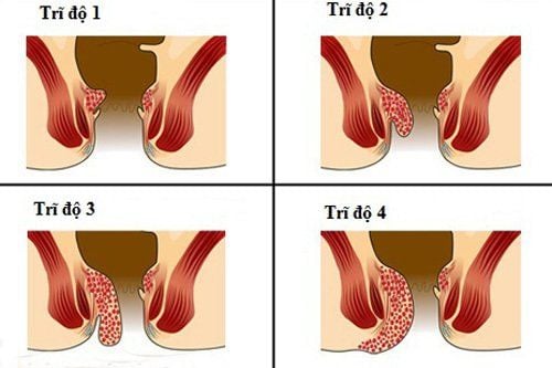 
Các mức độ trĩ nội
