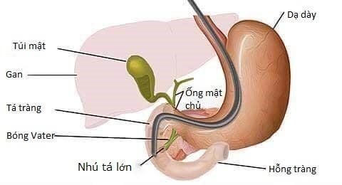 
Nội soi mật tụy ngược dòng
