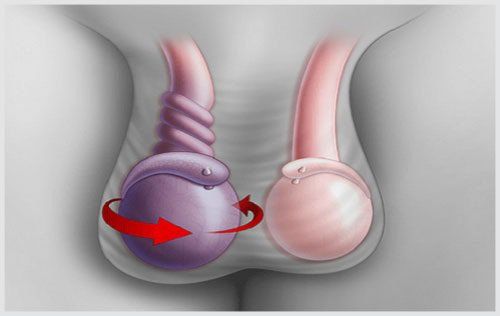 
Đau tinh hoàn có thể là triệu chứng bệnh xoắn tinh hoàn
