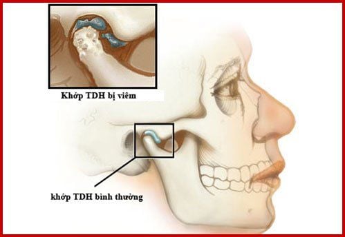 Viêm khớp thái dương hàm: Những điều cần biết