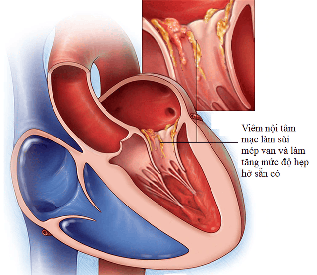 4. Cách Chẩn Đoán Bệnh Sùi Van Tim