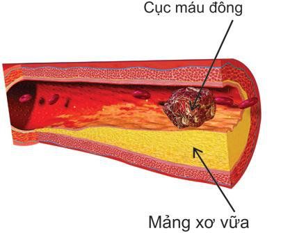 
Cục máu đông gây nên tai biến mạch máu não
