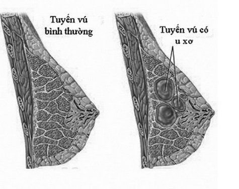 
U xơ tuyến vú
