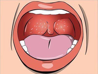 Inflamed tonsils, ulcers: What to do?