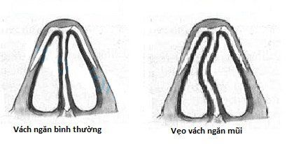 
Vách ngăn mũi bị lệch
