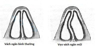 
Image of deviated nasal septum
