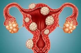 What size uterine fibroids can be embolized, without surgery?