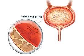 Vì sao viêm bàng quang dễ tái phát nhiều lần?