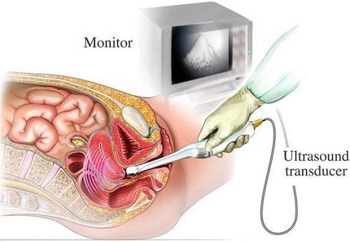 
Siêu âm đầu dò được sử dụng khi bác sĩ muốn kiểm tra những bất thường ở tử cung, buồng trứng, vòi trứng
