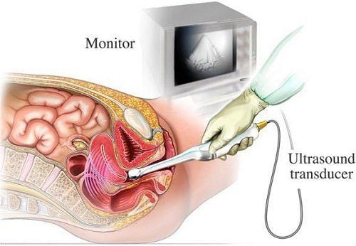 Indications for transvaginal ultrasound