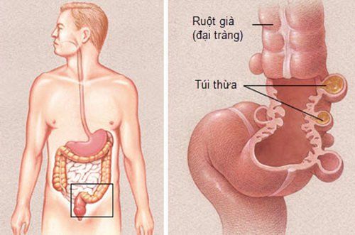 
Viêm túi thừa xảy ra khi một hoặc nhiều túi thừa của ống tiêu hóa bị viêm, nhiễm khuẩn
