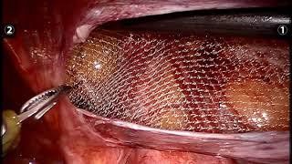 After surgery for inguinal hernia and placing the mesh, will the mesh be lost later?