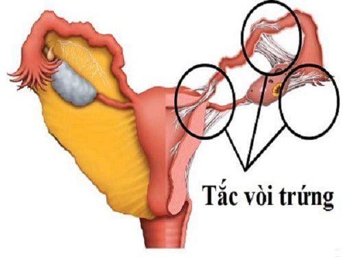 
Chụp X quang tử cung vòi trứng cho phép đánh giá tình trạng vòi trứng
