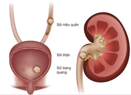 
Đặt ống thông có thể gây sỏi bàng quang
