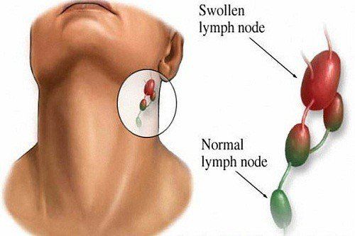 Diagnosis of lymph node tumors by ultrasound