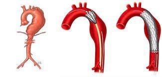 Laparoscopic surgery to treat bulging, occlusion, and narrowing of the lower abdominal aorta