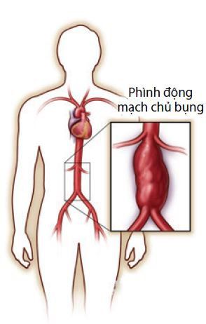 
Hiện tượng phình động mạch chủ bụng
