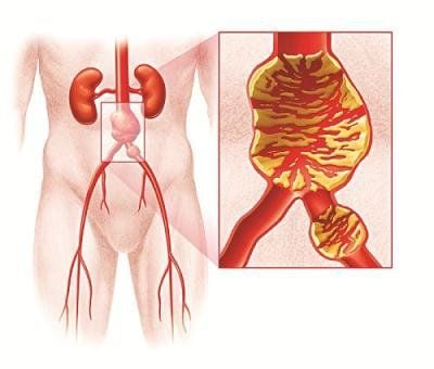 Complications and risk of rupture of abdominal aortic aneurysms