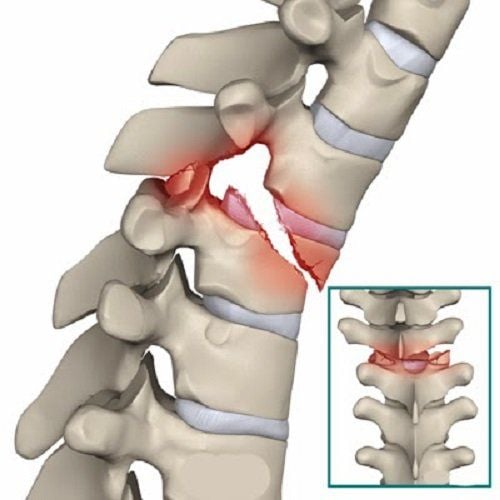 
Gãy xương sống có thể gặp ở bất kỳ vị trí nào trên cột sống
