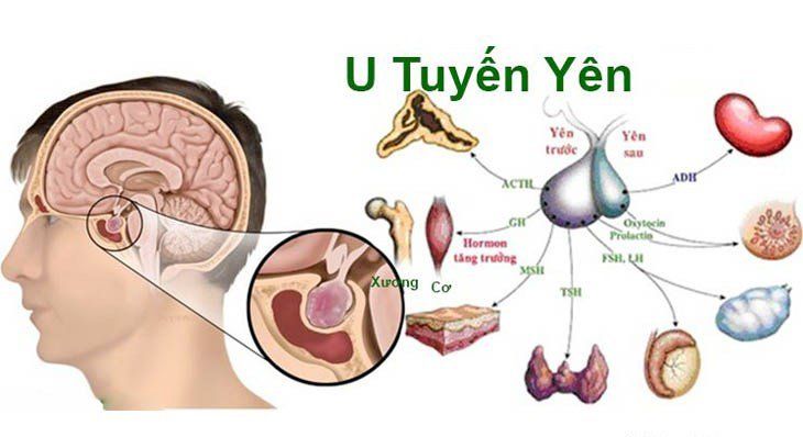 Thông tin về khối u ở tuyến yên trong não