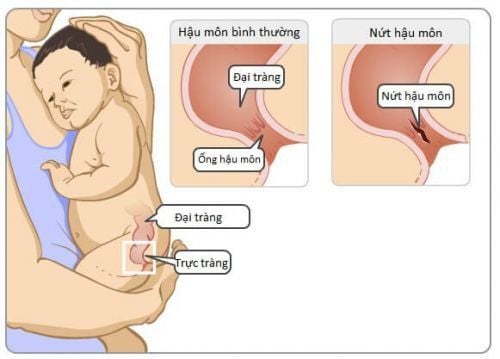 
Nứt kẽ hậu môn gây nhiều đau đớn cho trẻ em
