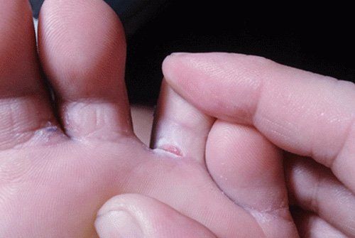 Symptoms of toenail fungus and how to treat it