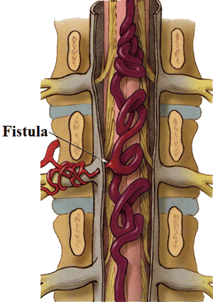 Intramedullary vascular malformation surgery