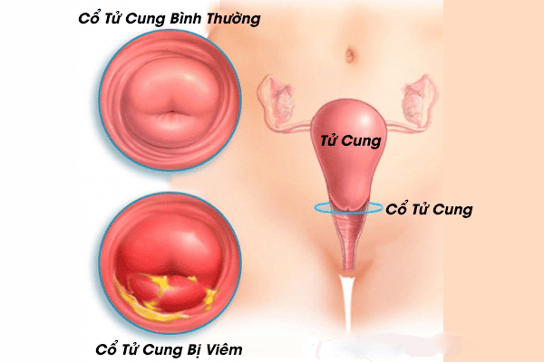 4. Phương pháp điều trị viêm cổ tử cung