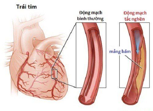 
Các mảng bám cholesterol vỡ và đông máu tắc nghẽn hoàn toàn động mạch tim có thể kích hoạt một cơn đau tim
