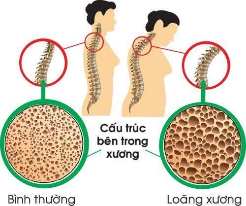 
Loãng xương gây cong vẹo cột sống
