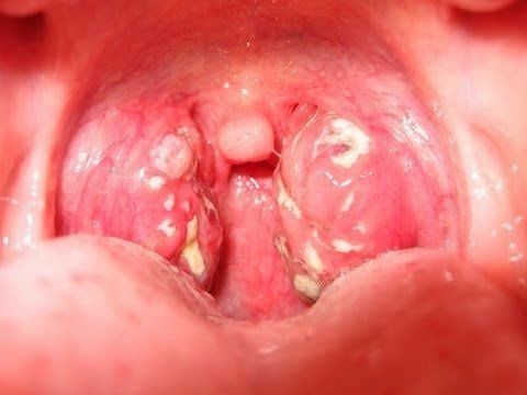 Is purulent tonsillitis dangerous?