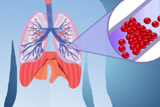 
Thuyên tắc mạch phổi (thuyên tắc phổi - pulmonary embolism - PE) là tình trạng tắc nghẽn mạch máu đột ngột ở phổi, ngăn chặn dòng lưu thông bình thường của máu trong vùng đó
