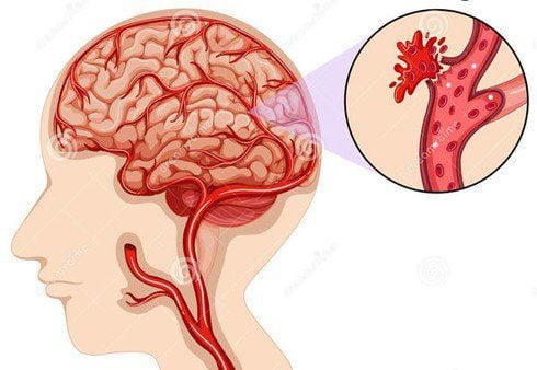 
Xuất huyết não là một trong số các nguyên nhân Chẩn đoán tăng huyết áp
