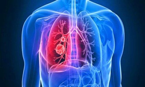 Biến chứng thường gặp của áp xe phổi