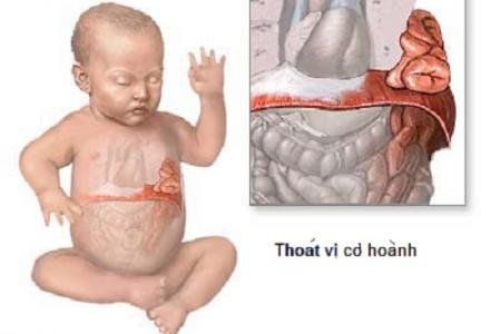 
Ở trẻ em, khiếm khuyết này có thể xảy ra ngay từ khi mới chào đời, gọi là thoát vị hoành bẩm sinh
