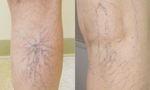 Is deep vein insufficiency dangerous?