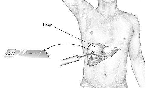 
Sinh thiết gan là một trong những phương pháp để chẩn đoán và đánh giá tình trạng xơ gan
