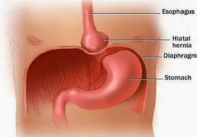 
Thoát vị hoành là một phần của dạ dày nhô ra vào trong khoang ngực
