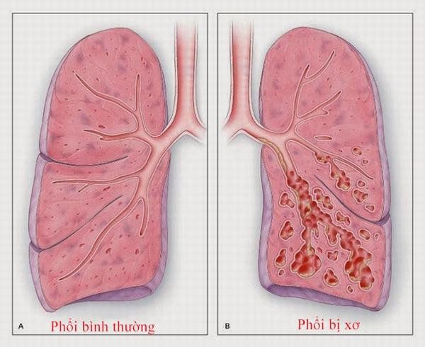 Bệnh Xơ Phổi: Nguyên Nhân, Triệu Chứng và Phòng Ngừa