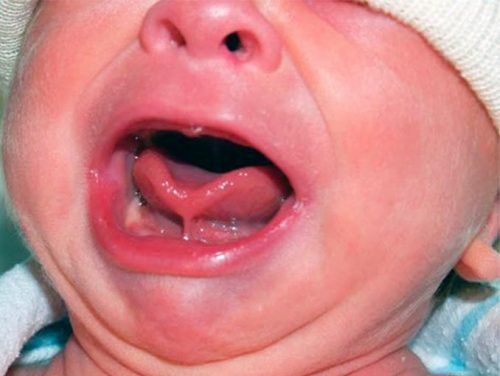 Learn about tongue-tie in children