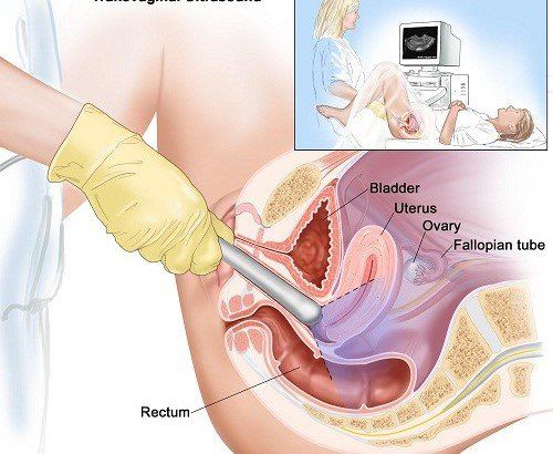 
Bác sĩ có thể đề nghị siêu âm để kiểm tra tình trạng của tử cung và buồng trứng
