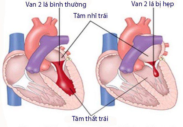 Evaluation of mitral stenosis on color Doppler echocardiography | Vinmec