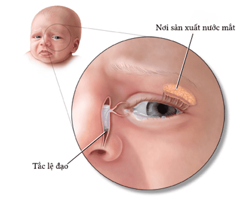 Recognizing lacrimal rules in infants