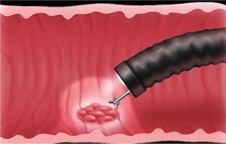 Gastric biopsy diagnoses intestinal metaplasia in the stomach