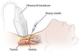 
Sinh thiết tuyến giáp giúp phân biệt một số bệnh lý và chẩn đoán ung thư
