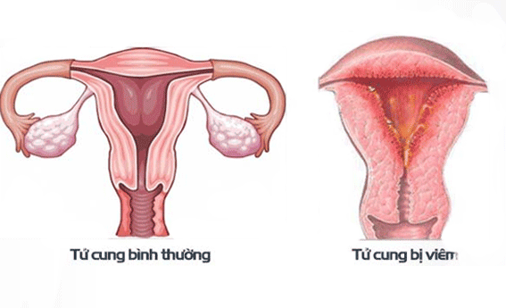 4. Các Phương Pháp Điều Trị Viêm Niêm Mạc Tử Cung