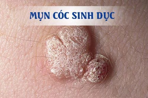 
Mụn cóc sinh dục là triệu chứng đầu tiên có thể phát hiện khi nhiễm một số loại HPV ở nam giới
