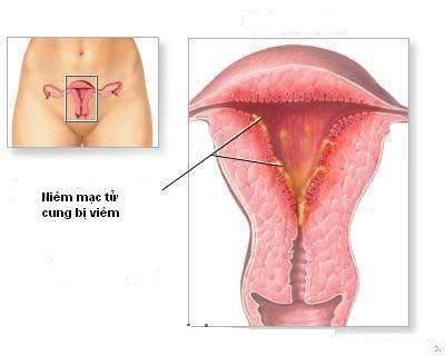 
Viêm niêm mạc tử cung
