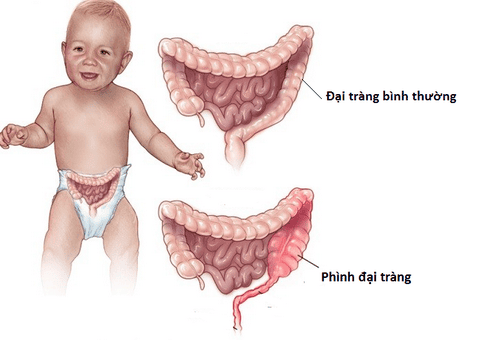 Congenital megacolon in children: Causes and signs to recognize