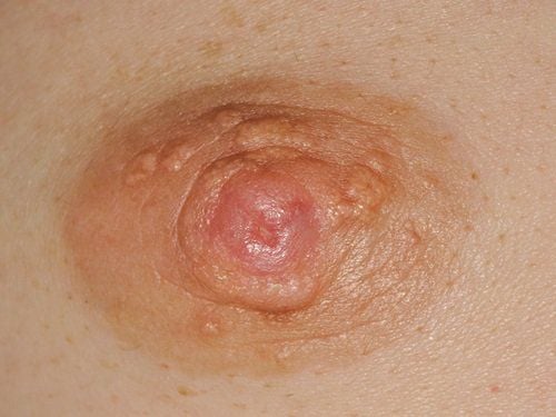 Nam giới nổi khối u ở vú có nguy hiểm không?